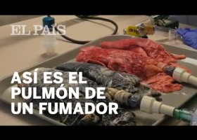 Así se transforma el pulmón de un fumador | Recurso educativo 788328